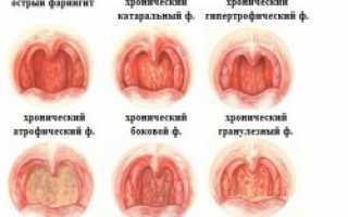 Гранулезный фарингит причины и лечение
