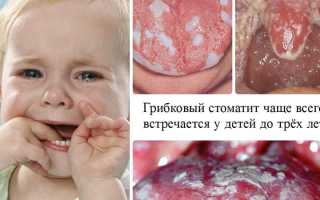 Чем лечить язвочки на языке у ребенка
