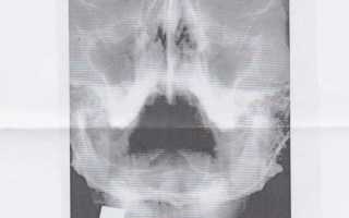 Рентгенологическое исследование при гайморите и критерии постановки диагноза