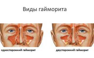 С чем лучше делать домашние ингаляции при гайморите