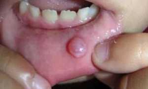 Волдырь на внутренней стороне губы