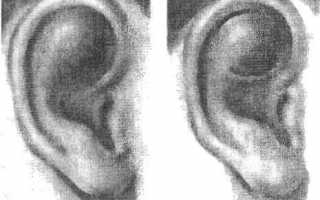 Перихондрит ушных раковин лечение и профилактика