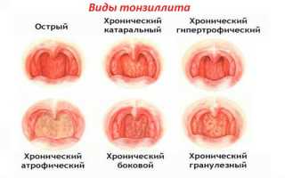 Первые признаки и лечение тонзиллита у ребенка