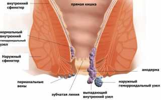 Симптомы и лечение кондилом в прямой кишке