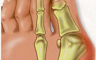 Косточка у большого пальца ноги болит и растет: что делать и как лечить