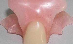Что такое зубной протез-бабочка