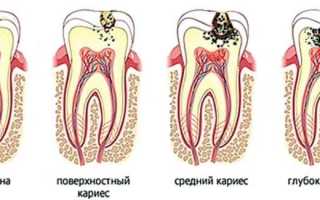 Как выглядит кариес на зубах: фото болезни