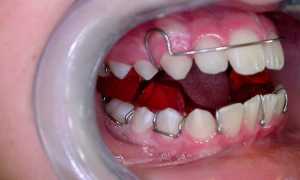 Пластины на зубы для выравнивания