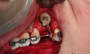 Удаление ретинированных и дистопированных зубов