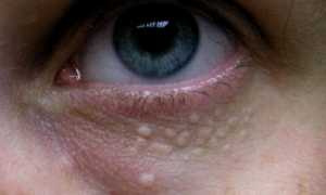 Жировик под глазами и в них — 10 причин возникновения и правильное лечение