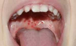Красные пятна во рту на нёбе: фото, причины сыпи