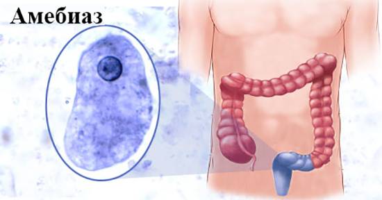 Амебиаз кишечника