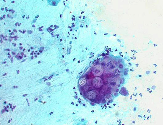 Chlamydia trachomatis