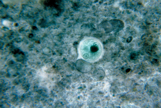 Entamoeba gingivalis