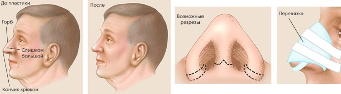 Виды операций септопластики носовой перегородки