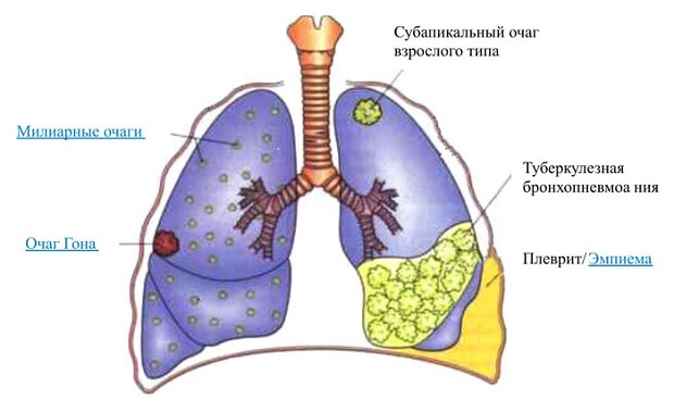 Почему болят легкие