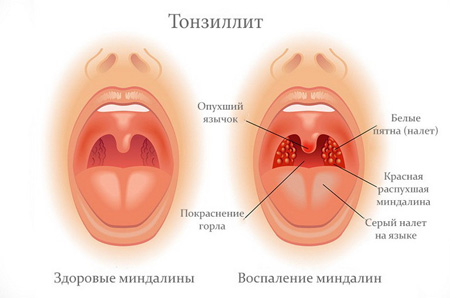 Может ли быть ангина без температуры