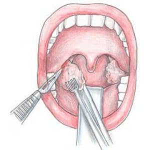Способы лечения и осложнения при кисте миндалины
