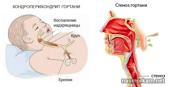 Болит гортань при глотании, вдохе или кашле. Причины и лечение