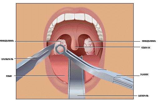 Лечение гипертрофии язычной миндалины