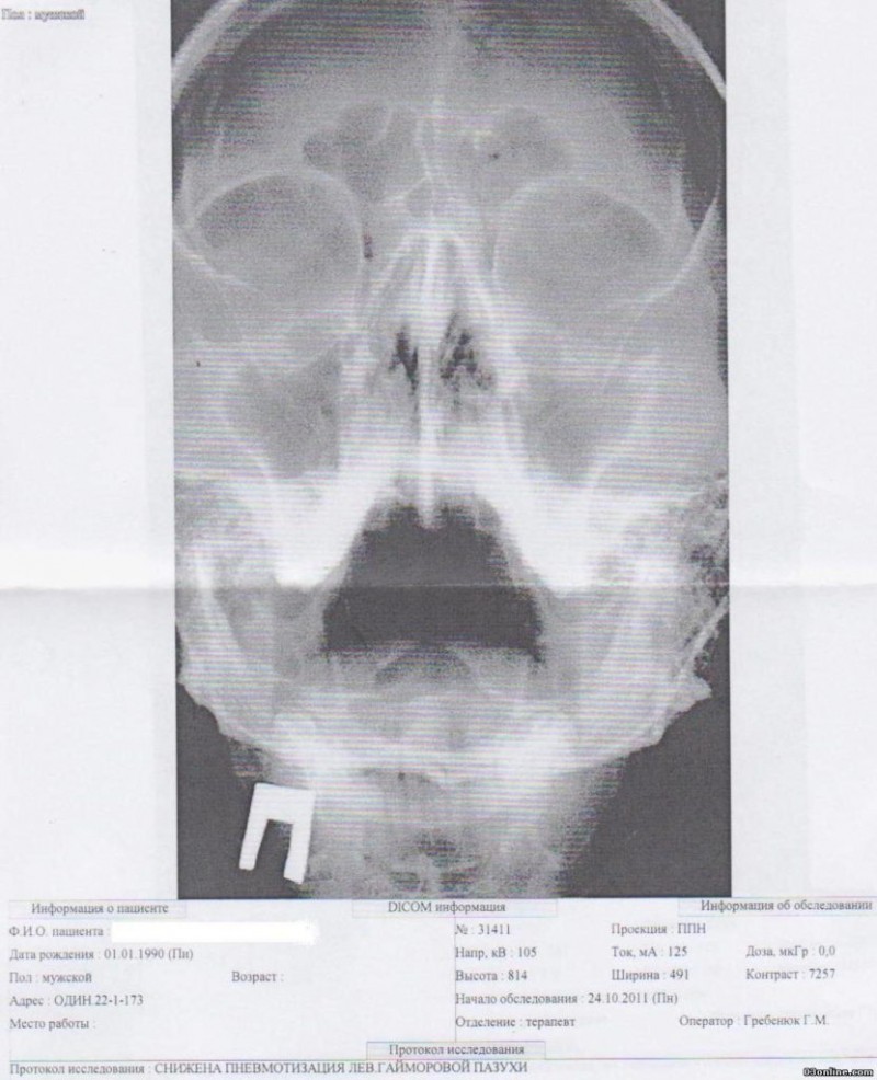 Рентгенологическое исследование при гайморите и критерии постановки диагноза