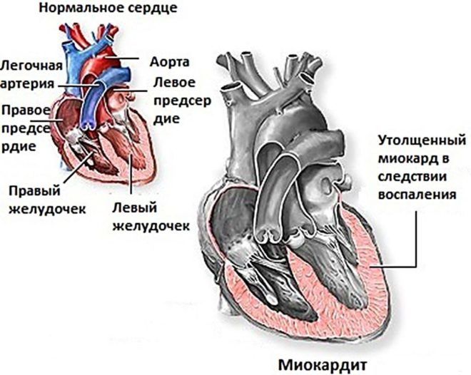 Скарлатина у ребёнка