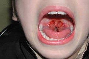 Симптомы и лечение острого тонзиллита у ребенка