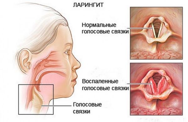 Инструкция по применению таблеток и леденцов для рассасывания при сухом и влажном кашле у детей