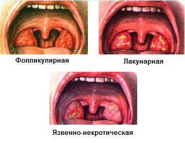 Методы эффективного лечения некротической ангины