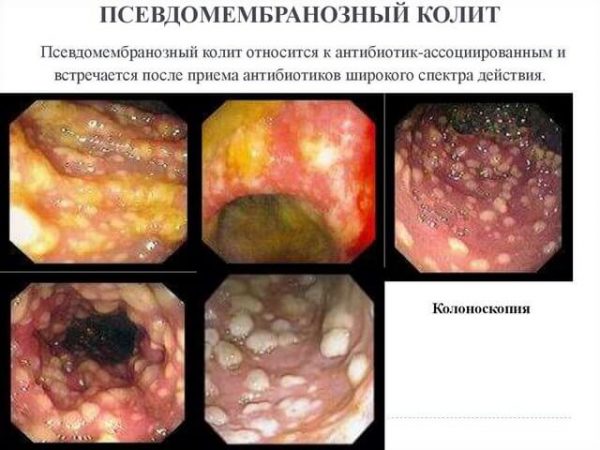 Антибиотик азитромицин при ангине