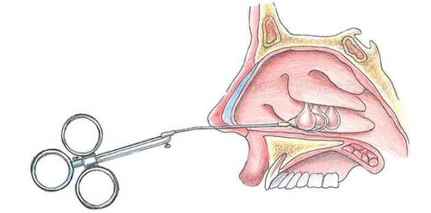 Хирург использует крючок Ланге для удаления полипов в носу