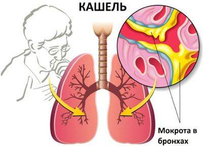 Лечение и профилактика воспаления бронхов