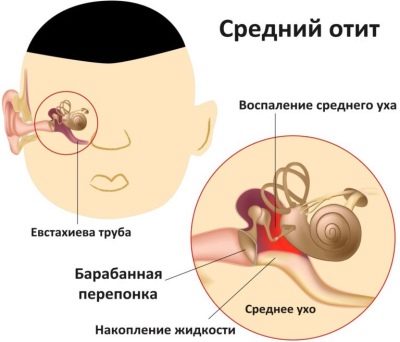 Как понять по симптомам, что у грудничка болит ухо