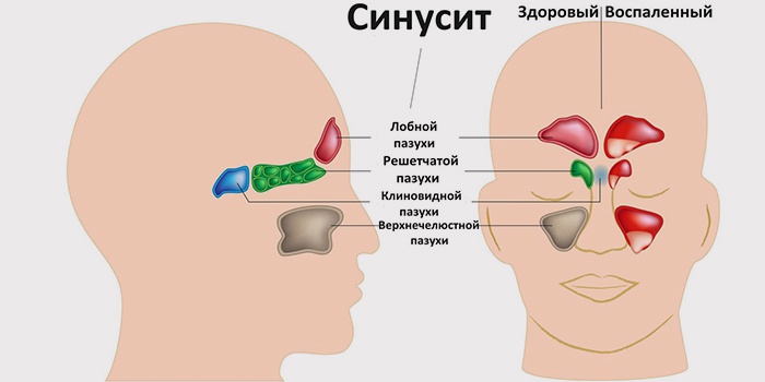 Опасна ли киста в носовой пазухе