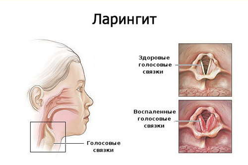 При каком типе кашля и как применяется Лазолван