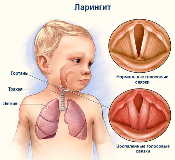 Ларингит - заразен или нет?