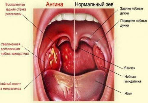 Ангина — причина боли корня языка