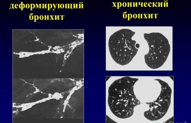 Лечение и профилактика воспаления бронхов