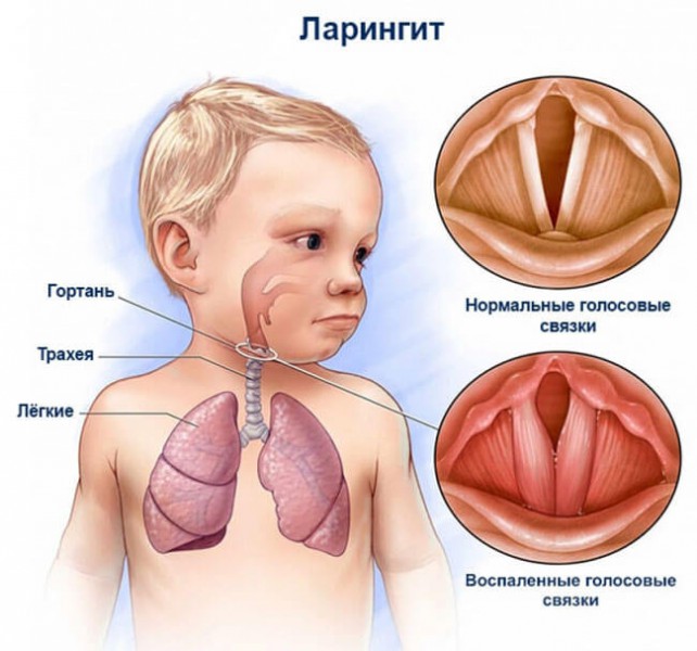 Лечение ларингита у детей препаратами и народными средствами