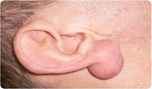 Болит мочка уха - причины и лечение