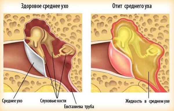 Как понять по симптомам, что у грудничка болит ухо