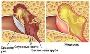 Причины заложенности уха в самолете