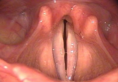 Парез голосовой связки и ее лечение