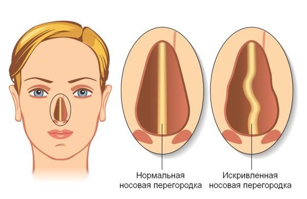 Самые эффективные средства от храпа в аптеках