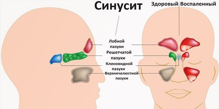 Воспаление придаточных пазух носа