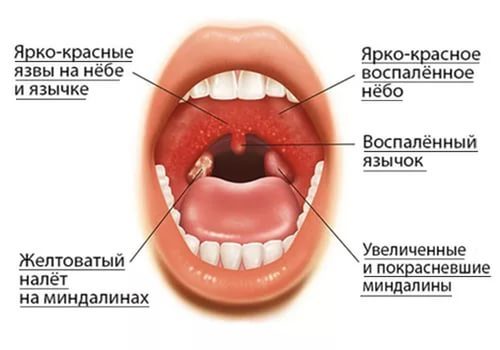 Методы эффективного лечения некротической ангины