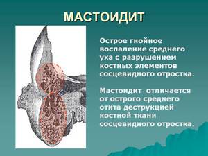 Левосторонний мастоидит характеристика симптомы лечение прогноз