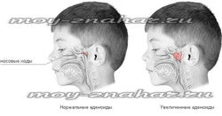 На какие симптомы аденоидов у детей стоит обратить внимание
