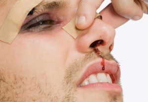 Признаки и лечение сломанного носа