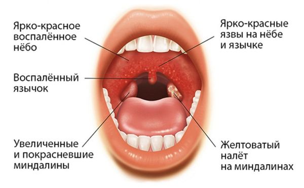 Доступные заменители препарата Тонзилгон Н